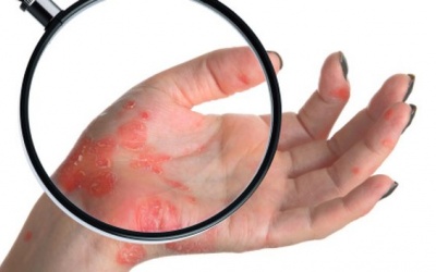 Những thực phẩm nên tránh khi bị vẩy nến