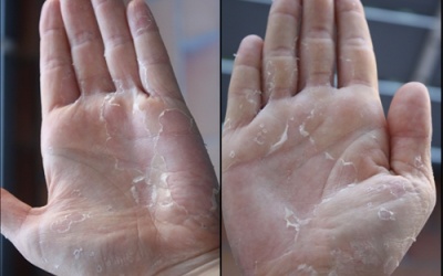 Tróc da bàn tay có phải do thiếu vitamin C?