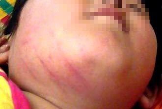 Phụ huynh tố cô giáo dùng thước gỗ đánh bầm mặt trẻ