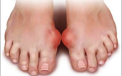 Có cần uống thuốc mỗi ngày để phòng ngừa bệnh Gout?