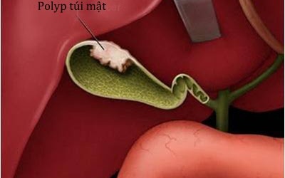 Polyp túi mật có dùng được TPCN Kim Đởm Khang?
