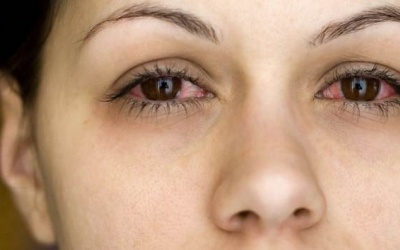 5 mẹo đơn giản chữa đau mắt đỏ ngay tại nhà