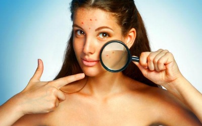 Rượu: Tác nhân hàng đầu gây mụn trứng cá