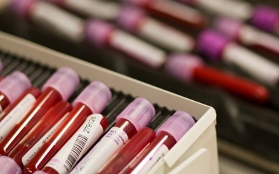 Nồng độ acid uric cao có làm giảm nguy cơ mắc bệnh Parkinson?