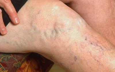 Chân nổi nhiều gân xanh: Chớ dại mà chủ quan!