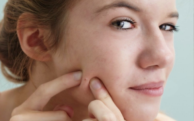 Nặn mụn trứng cá – Sai lầm nhiều người đang mắc phải