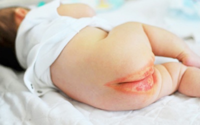 Trị hăm tã theo cách dân gian cho trẻ 