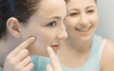 Kem thảo dược Azacne có trị được mụn?