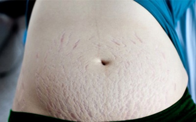 Một số biện pháp chống rạn da tự nhiên cho mẹ bầu