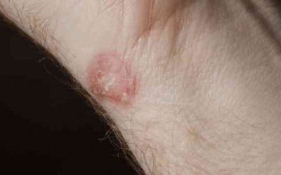 6 cách tự nhiên giúp 'thổi bay' bệnh nấm da hiệu quả