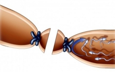 Chồng thắt ống dẫn tinh vợ vẫn có bầu