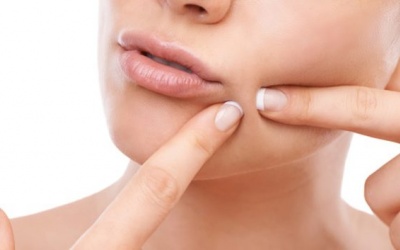 6 cách trị mụn trứng cá tuyệt đối không nên thử