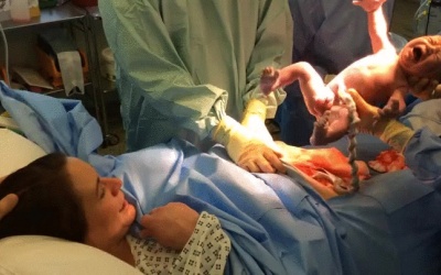 Em bé tự chui ra khỏi bụng mẹ trong một ca sinh mổ tự nhiên