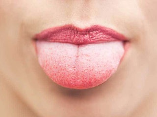 Liệu pháp chữa bệnh tưa tại nhà