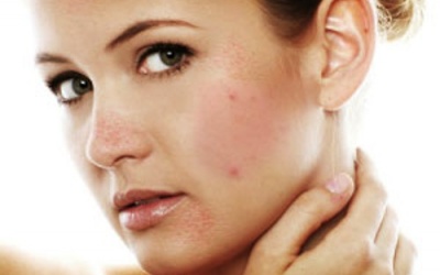  Cải thiện làn da đầy mụn trứng cá với sản phẩm thảo dược