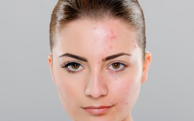 6 loại thuốc có thể là nguyên nhân gây mụn trứng cá