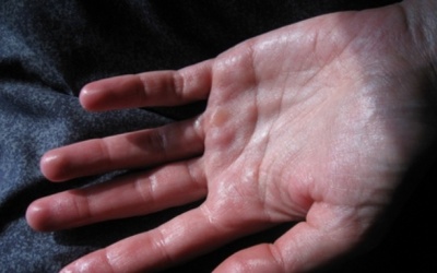 Điều trị ra mồ hôi tay, chân thế nào cho hiệu quả?