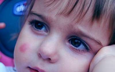 Mẹ cần làm ngay điều này khi trẻ bị côn trùng đốt