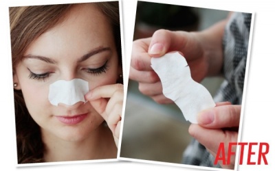 Có nên sử dụng miếng dán lột mụn để trị trứng cá?