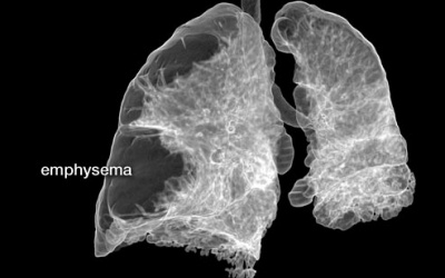 Các phương pháp phẫu thuật cho bệnh nhân khí phế thũng