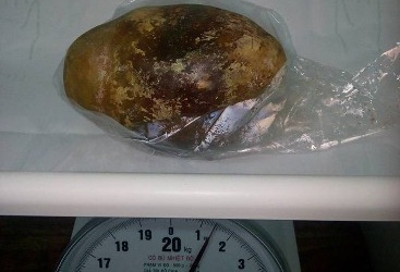 Hy hữu viên sỏi bàng quang nặng 1,5kg