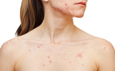 Mụn trứng cá có lây lan không?