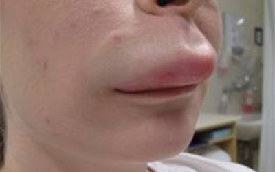 Phù môi, phù mắt có phải bị mề đay?