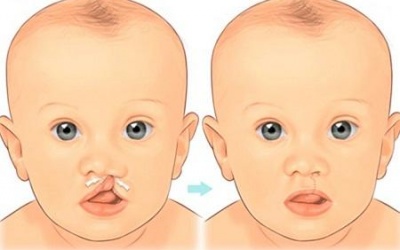 Điều trị hở hàm ếch như thế nào?