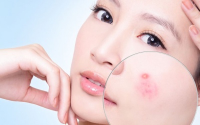 5 cách loại bỏ mụn nhọn đơn giản đến bất ngờ