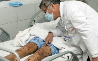 TP.HCM xuất hiện viêm não mô cầu: Làm gì để phòng tránh?