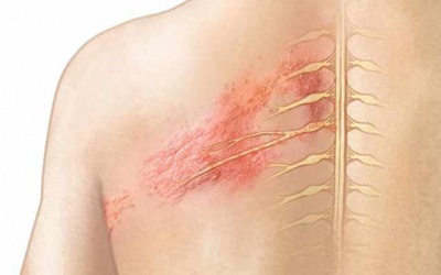 Bệnh zona thần kinh có lây không?