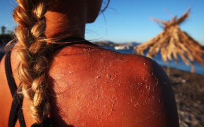 Phải làm gì khi bị say nắng, bỏng nắng nặng?