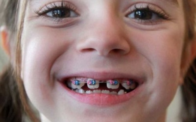 Chăm sóc niềng răng cho con như thế nào?