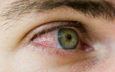 Mắt xuất hiện nhiều gân màu đỏ là bệnh gì?