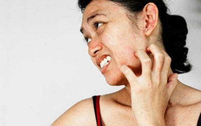 Ngứa, nổi đốm đỏ trên mặt và bàn tay khi ra nắng là bệnh gì?