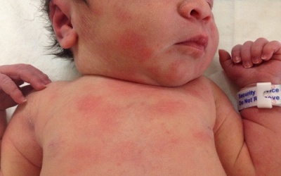 “Thủ phạm' khiến da bé kích ứng