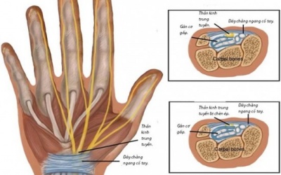 Bệnh thường gặp của người làm báo