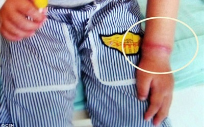 Cảnh báo: Cậu bé 4 tuổi suýt bị cắt tay vì một chiếc vòng chun