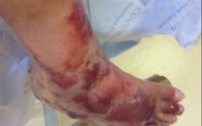 Người đàn ông bị vi khuẩn ăn thịt chân sau chuyến đi biển