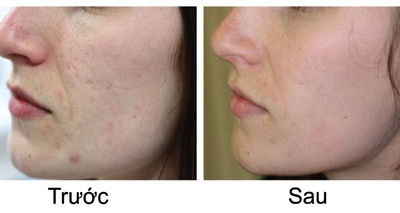 Bí quyết làm mờ thâm sẹo do mụn chỉ sau 1 tuần