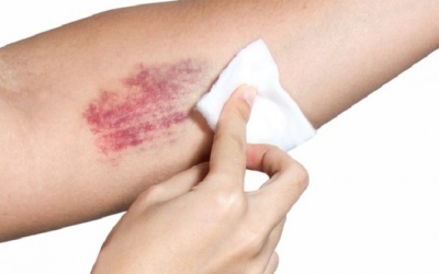 8 cách tự nhiên giúp chữa lành vết bầm tím trên cơ thể