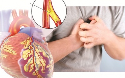 Điều trị bệnh mạch vành như thế nào?