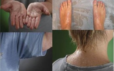 Mồ hôi nhiều: Dấu hiệu của nhiều căn bệnh nguy hiểm