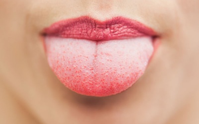 Màu sắc của lưỡi cảnh báo bệnh tật