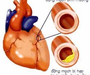 Hẹp động mạch vành nên điều trị thế nào?