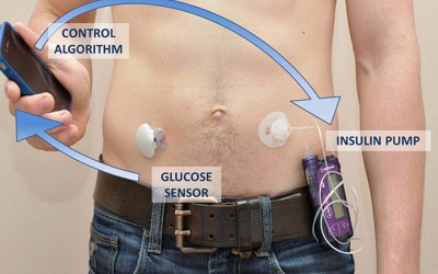 'Tuyến tuỵ nhân tạo' giúp bệnh nhân đái tháo đường sống như người thường