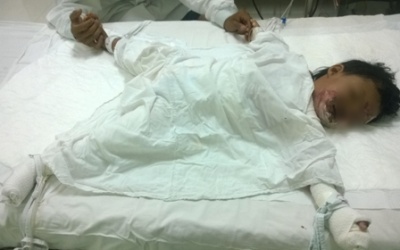 Dì dùng xăng nhóm bếp, bé 2 tuổi bỏng nặng