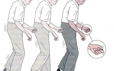 Bệnh Parkinson có thể điều trị khỏi không?