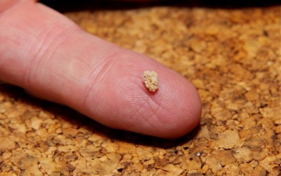 Có cách nào ngăn ngừa sỏi thận tái phát?