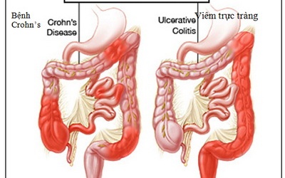 Đừng để bị bệnh đại tràng nặng mới lo chạy chữa.